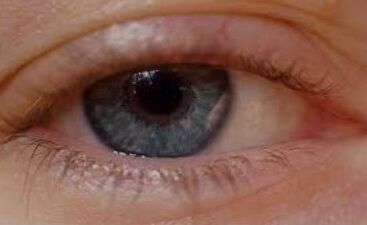 Oculax cura a blefarite
